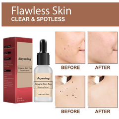 Skin Care Solution to Remove Dark Nevus and Warts (1pc)